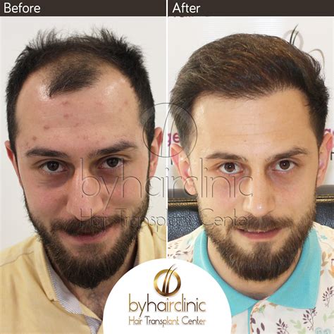 best hair transplant turkey istanbul.